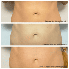 Morpheus8 Before And After Image | EMME Medical Spa | Orchard Park, NY