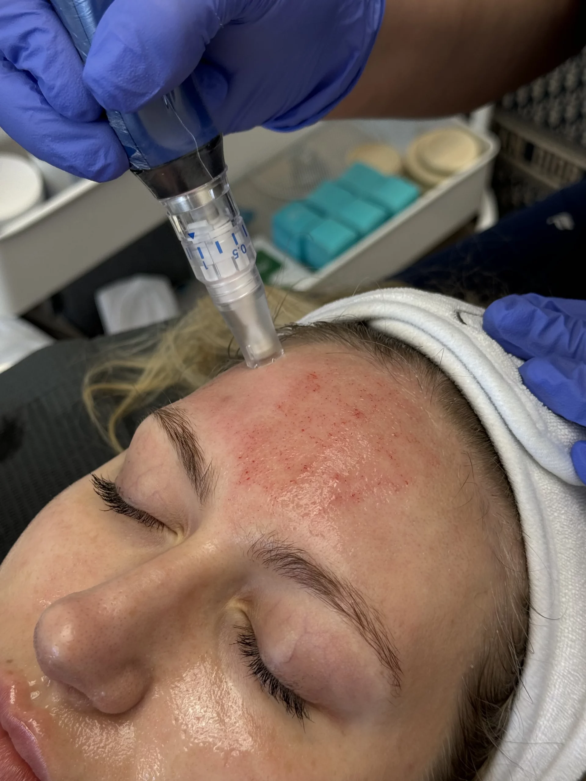 SkinPen Microneedling scaled