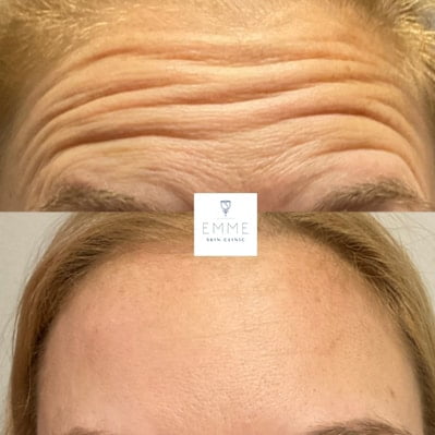 xeomin f before and after