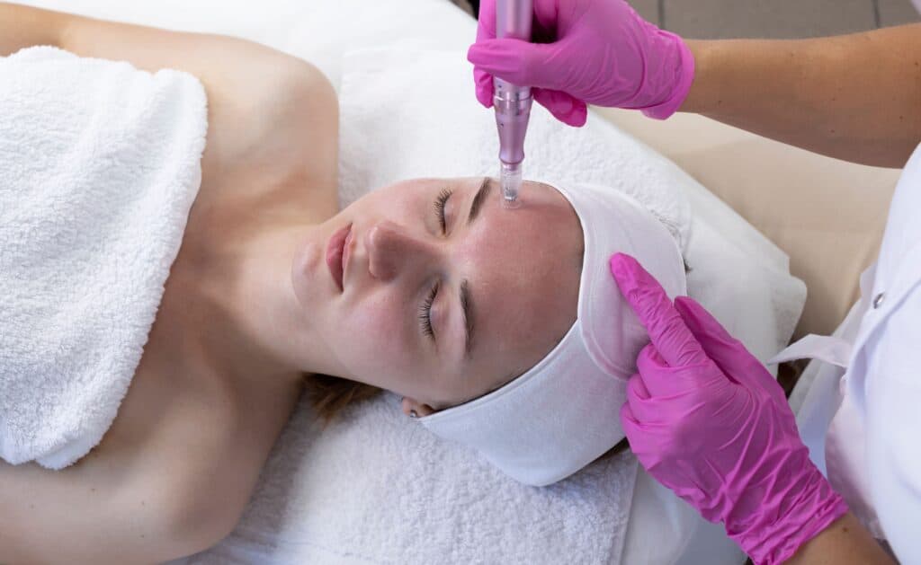 Skin-Pen-Microneedling-By-emmeskinclinic-in-Orchard-Park- NY
