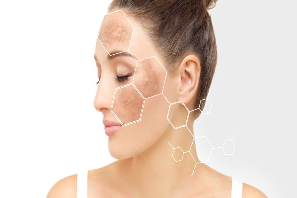 Hyperpigmentation-By-emmeskinclinic-in-Orchard-Park