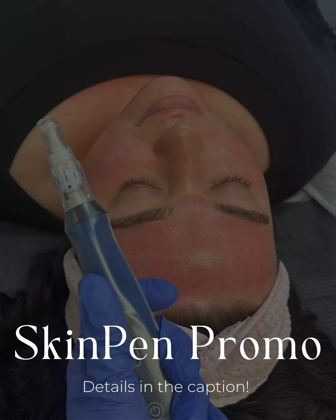 Skinpen Promo