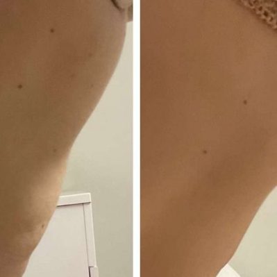 Morpheus8 Before And After Image | EMME Medical Spa | Orchard Park, NY