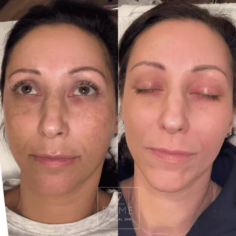 Zo Skin Before & After 1