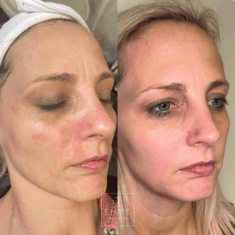 Zo Skin Before & After 11