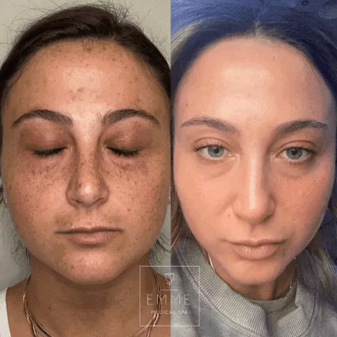 Zo Skin Before & After 7