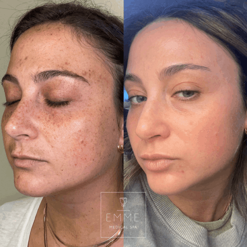 Zo Skin Before & After 8