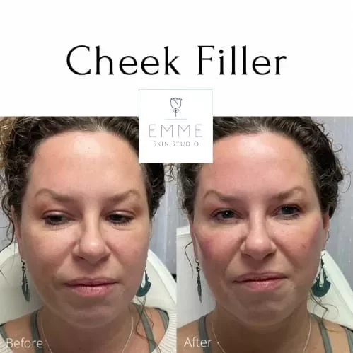 cheek-filler-a-before-