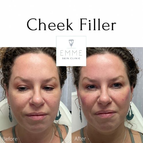 cheek-filler-a-before-and-after-py8d802pdbenqlfn2dmsw4jl44x22akpff0ml1kq4e