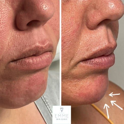 cheek-filler-b-before-and-after-py8d8kr5jo6yu0llpmklezbq6m34rmusu9db54q2bi