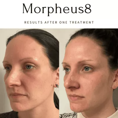 Morpheus8 Before And After Image | EMME Medical Spa | Orchard Park, NY