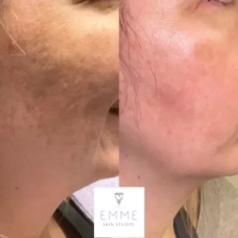 emmedmedicalspa-zoskin1