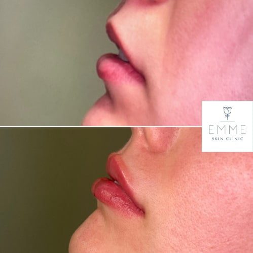 injectables-b-before-and-after-py8d3wi1kbsn3te003udins7un4fhtauj4le8lnj9a