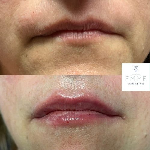 injectables-d-before-and-after-py8d6hk2cxc117mtwq2fviaunsdrnuk9vx6gqztk5a