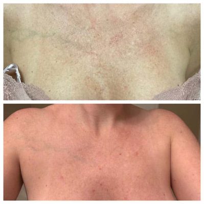 SKIN BRIGHTENING Before And After Image | EMME Medical Spa | Orchard Park, NY