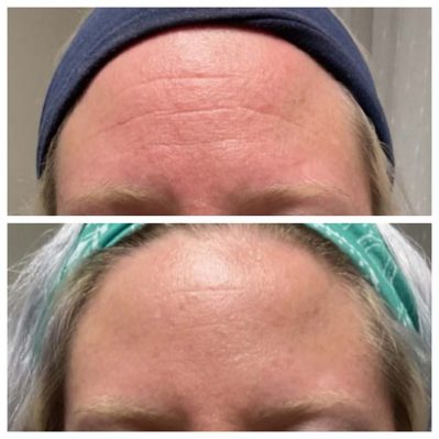 Botox Before And After Image | EMME Medical Spa | Orchard Park, NY
