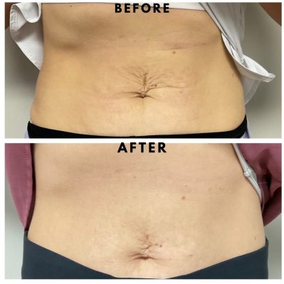 Skin Tightening Before And After Image | EMME Medical Spa | Orchard Park, NY