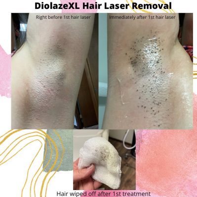 Diolaze XL Hair Laser Removal | EMME Medical Spa | Orchard Park, NY