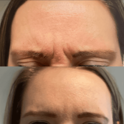 Xeomin Before And After Image | EMME Medical Spa | Orchard Park, NY