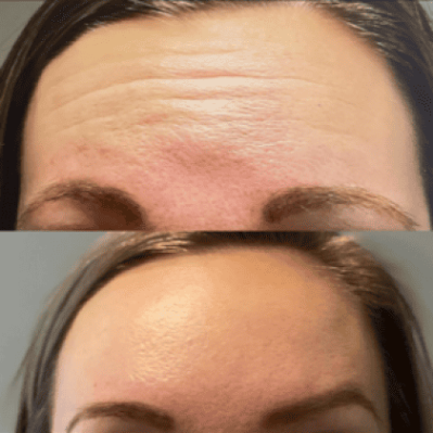 Xeomin Before And After Image | EMME Medical Spa | Orchard Park, NY