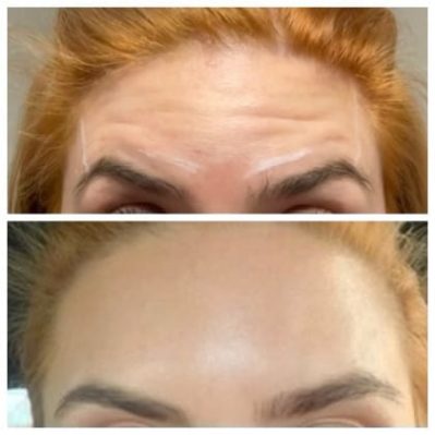 Xeomin Before And After Image | EMME Medical Spa | Orchard Park, NY