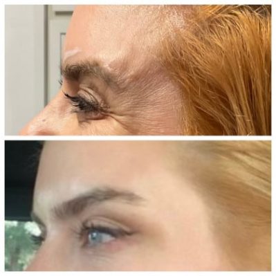 Xeomin Before And After Image | EMME Medical Spa | Orchard Park, NY