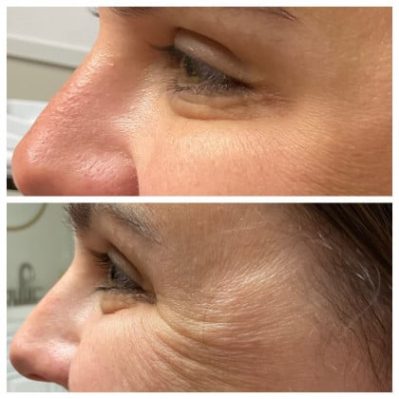 Xeomin Before And After Image | EMME Medical Spa | Orchard Park, NY