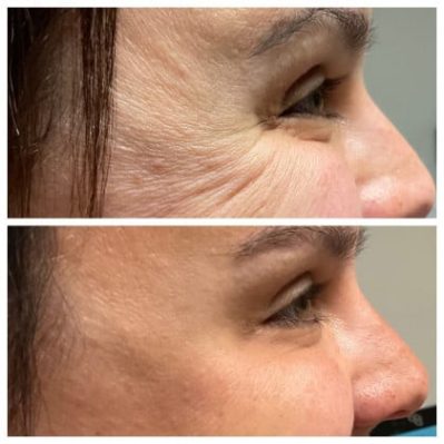 Xeomin Before And After Image | EMME Medical Spa | Orchard Park, NY