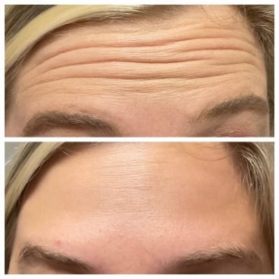 Xeomin Before And After Image | EMME Medical Spa | Orchard Park, NY