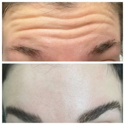 Xeomin Before And After Image | EMME Medical Spa | Orchard Park, NY