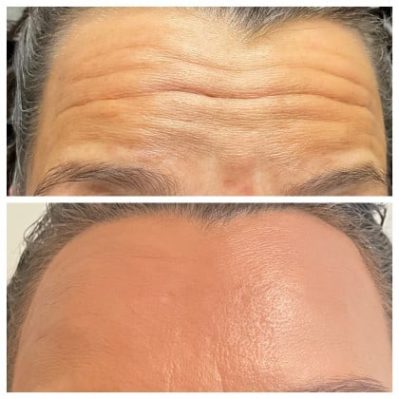 Xeomin Before And After Image | EMME Medical Spa | Orchard Park, NY