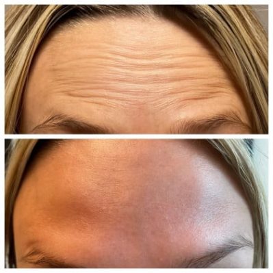 Xeomin Before And After Image | EMME Medical Spa | Orchard Park, NY