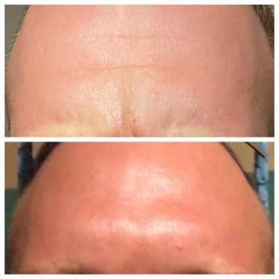 Xeomin Before And After Image | EMME Medical Spa | Orchard Park, NY