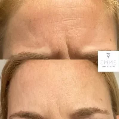 xeomin-h-before-and-after